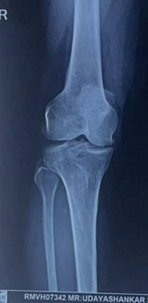 Knee Replacement — before 1
